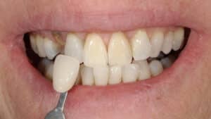 After Image: Teeth Whitening