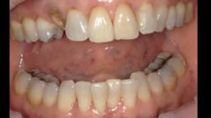 Before Image: Teeth Whitening