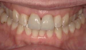 Before Image: Dental Crowns