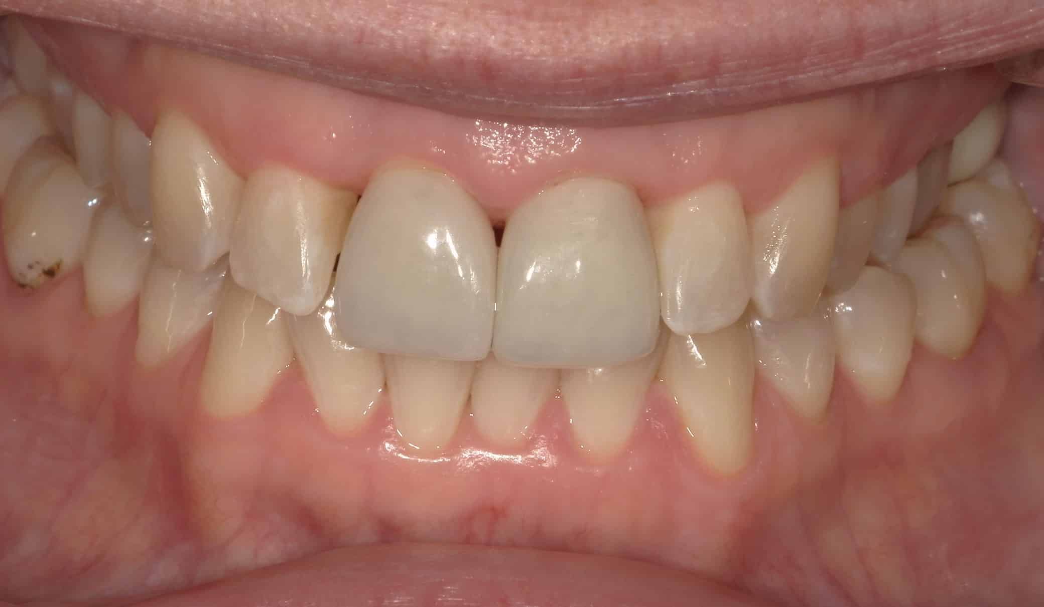 porcelain crowns results ashland OH