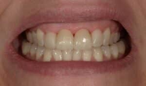 After Image: Dental Crowns