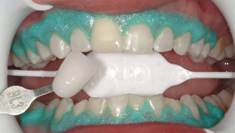 After Image: Teeth Whitening - front