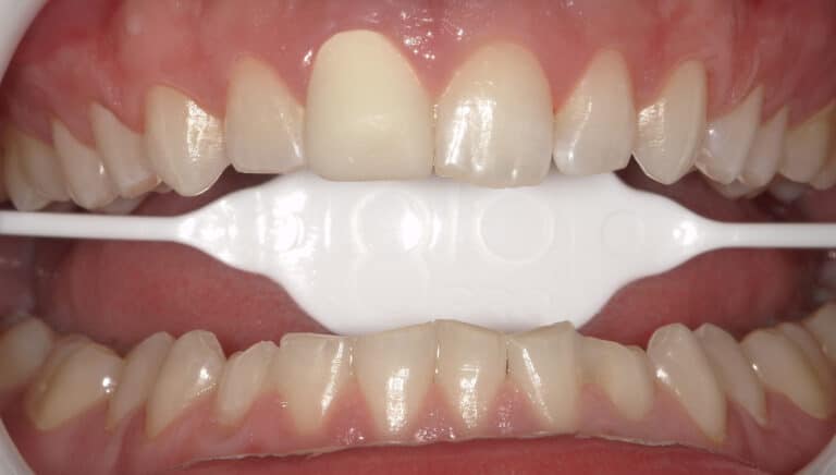 Before Image: Teeth Whitening - front