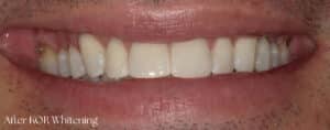After Image: Teeth Whitening