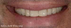 Before Image: Teeth Whitening