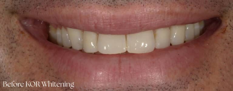 Before Image: Teeth Whitening - front