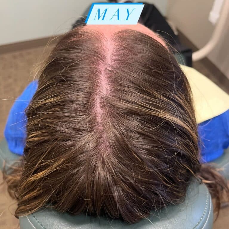 After Image: Hair Regrowth Treatment - back