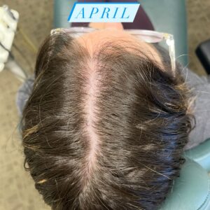 Before Image: Hair Regrowth Treatment