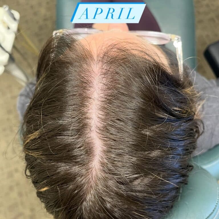 Before Image: Hair Regrowth Treatment - back