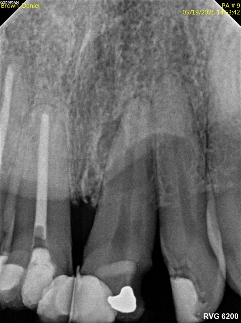 Before Image: Root Canal - front