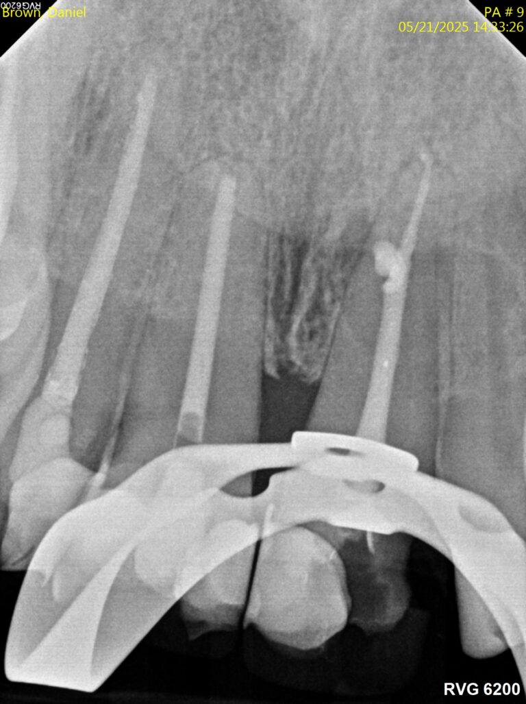 After Image: Root Canal - front